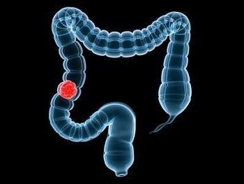 Gastroenterologul vă va spune cum să vă verificați intestinele