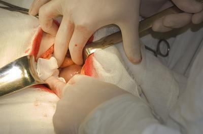 Operația abdominală pentru a elimina chistul ovarului și uterului